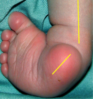 Assessing Children With Clubfoot Physiopedia