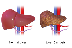 Liver cirrhosis.png
