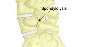 Spondylolysis fracture.jpg