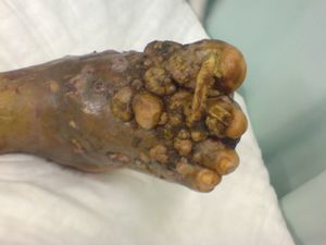Fungal Madura foot..jpeg