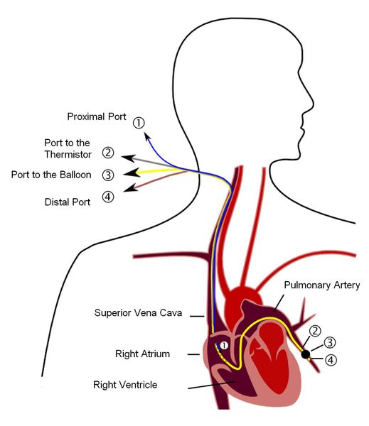 File:Pulmonary artery catheter english.jpeg
