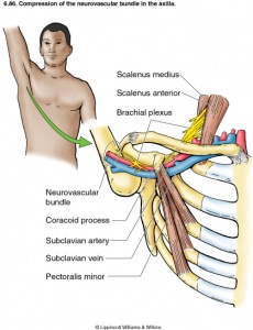 Costoclavicular Syndrome - Physiopedia
