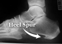 inferior and posterior calcaneal spurs