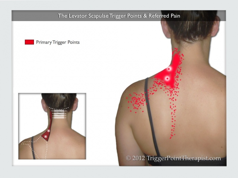 File:Levator scapula trigger points referred pain.jpg
