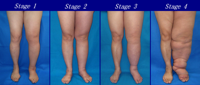 Lymphedema stages.png
