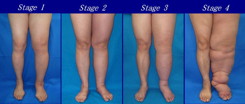 File:Lymphedema stages.png
