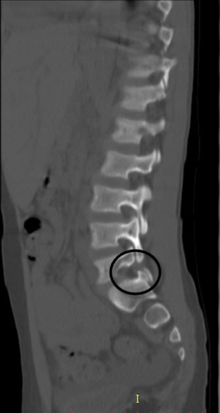 File:Spondylolisthesis MRI.jpg