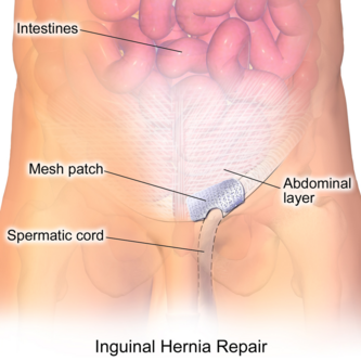 perineal hernia in women