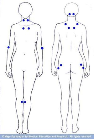 X marks the spot : r/Fibromyalgia