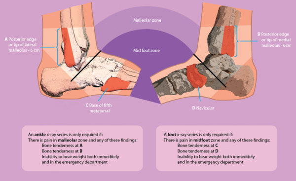 Inversion Ankle Sprain: PT Treatment Protocol