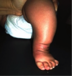 Case Study- Idiopathic Unilateral Clubfoot 3.png