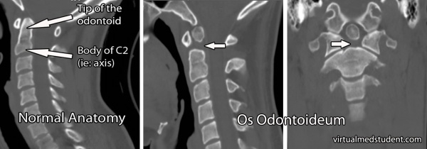 Os odontoideum coronal and sagittal.jpg
