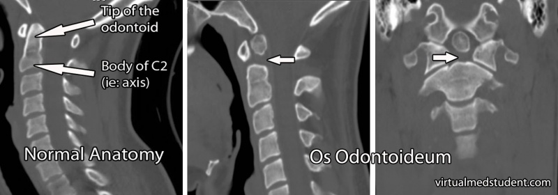 File:Os odontoideum coronal and sagittal.jpg