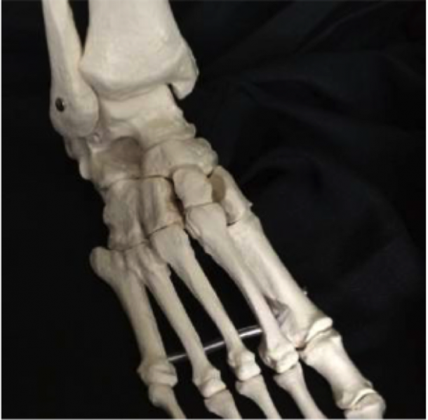 File:Clubfoot2.png