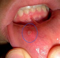This could be how oral ulceration looks in a person with SLE. This image was included courtesy of http://www.thedailystar.net/photo.