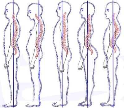 Lateral curvature of the spine and round shoulders . will sometimesshow a  slight tendency to curve to the right in the dorsal region, which  FUNCTIONAL SCOLIOSIS. SI may be due to