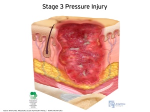 pressure ulcer stage 1 foot