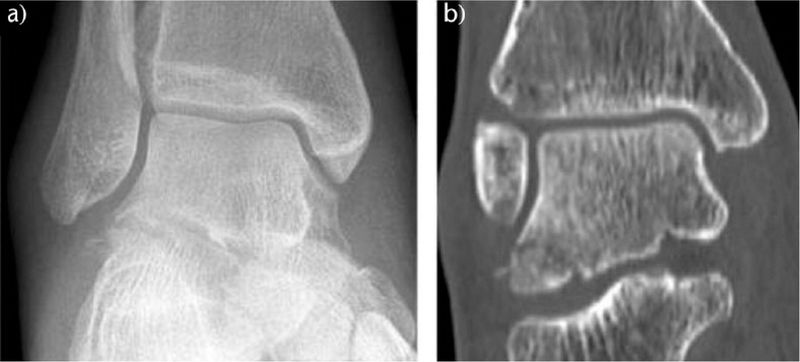 File:Fracture of the lateral process of talus .jpeg