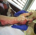 Pseudo-eschar formation over burn wound on hand. Photo used with kind permission from Diane Merwarth, PT