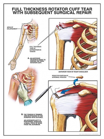 449px-Rotator cuff high.jpg