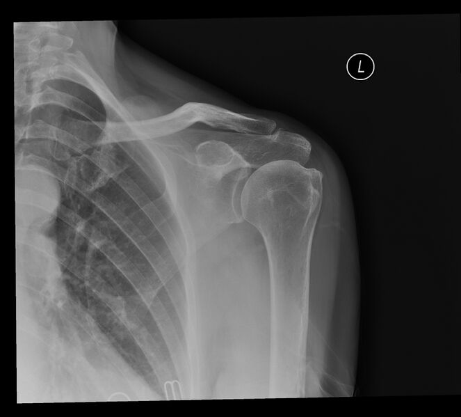 File:Degeneration-of-the-acromioclavicular-joint.jpeg
