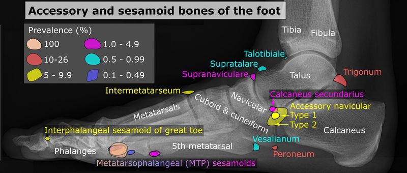 File:Accessory and sesamoid bones of the foot - lateral projection.jpg