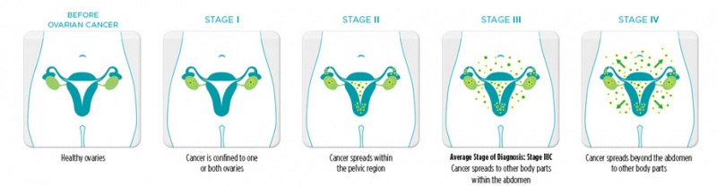 File:Stages cancer.jpg