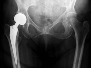 Everything You Need To Know About Direct Anterior Hip Replacements - Iowa  Ortho