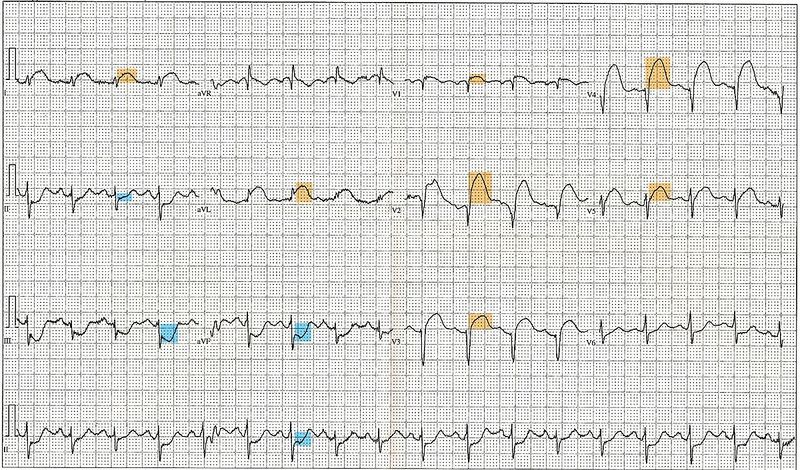 File:1200px-12 Lead EKG ST Elevation tracing color coded.jpg