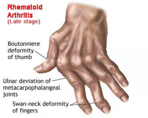 arthritis hands early signs