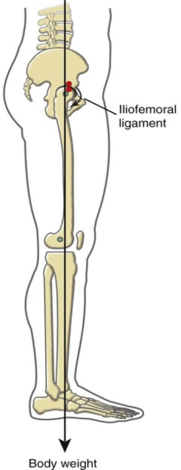 Postoperative brace with the hip placed in 30° to 40° of flexion.