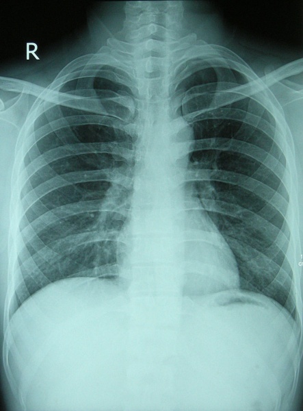 File:Chest X-ray 2346.jpg