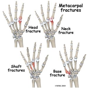 Types of metacarpal fractures.jpg