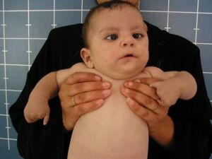 Photograph of young baby with Moebius Syndrome, showing upper part of body, the face and both upper limbs. Subtotal absence of the phalanges (preservation of the hypoplastic thumbs and hypoplastic 5th fingers, respectively) in a patient with oromandibular-limb hypogenesis syndrome. Also note the esotropia, due to bilateral sixth nerve palsies.