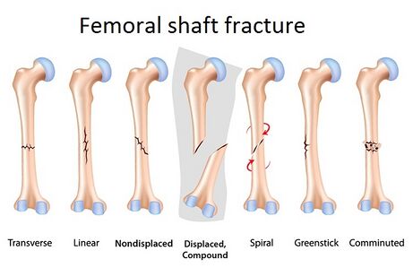 Femur (Thighbone): Anatomy, Function & Common Conditions