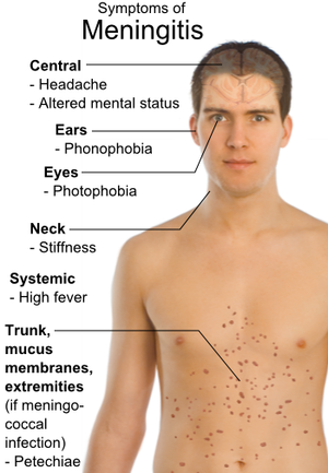 Symptoms of Meningitis.png