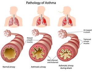 Respiratory health and exercise-induced asthma