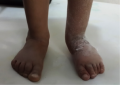 Case Study-Clubfoot with Post-Surgical Relapse.png
