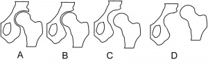 Hip dysplasia schematic.jpg