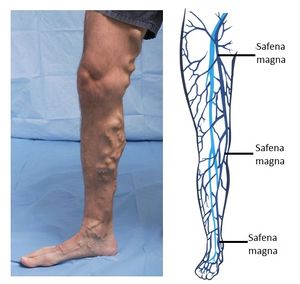Deep Vein Thrombosis for Fort Collins, CO, Apex Endovascular