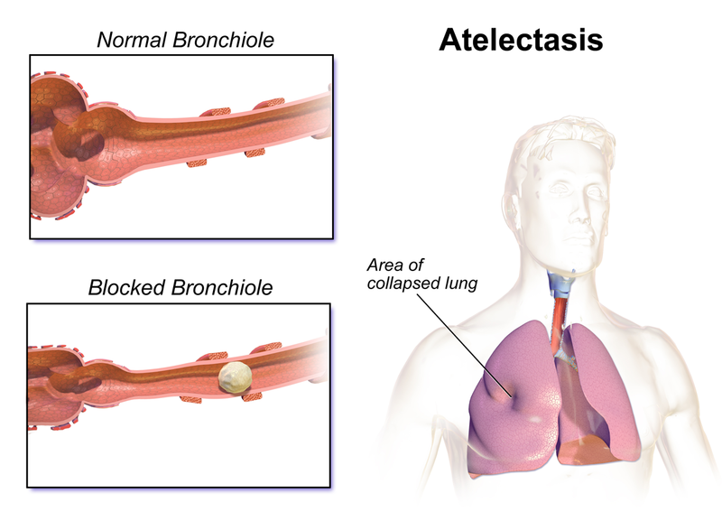 File:Atelectasis and blockage.png