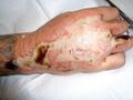 Eschar formation over burn wound on hand. Photo used with kind permission from Diane Merwarth, PT
