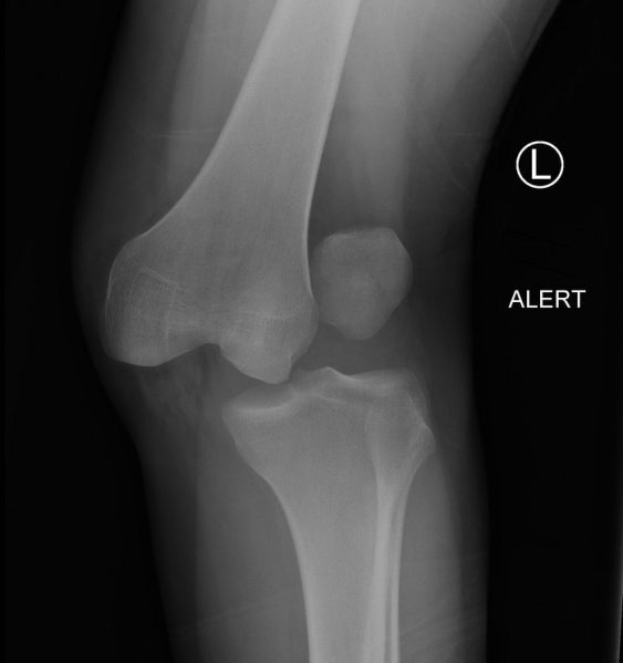 File:Lateral-knee-dislocation-1.jpg