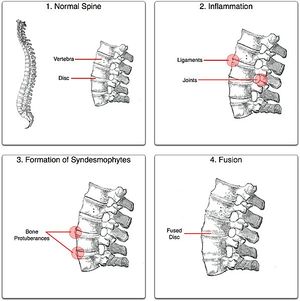 The Ankylosing Spondylitis Disease Activity Score (ASDAS) is the  recommended instrument in axial SpA​. Poll:​ Do you use the ASDAS for  disease activity measurement in axSpA in your clinical practice?​ A.  Yes​ 