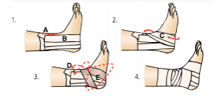 Ankle sprain: recovery process and rehabilitation - Medicofit