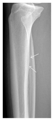 compression fracture arm