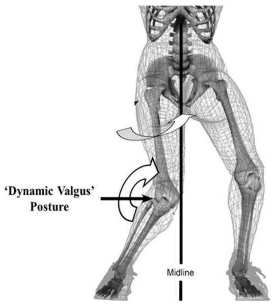 File:Dynamic knee valgus.png