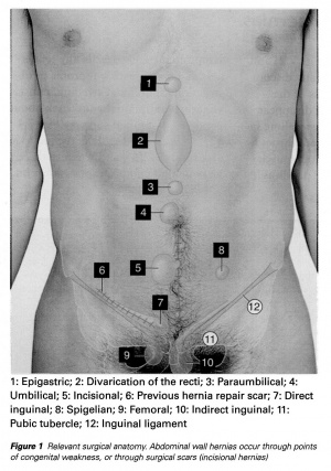 Hernia Pictures of 6 Common Types