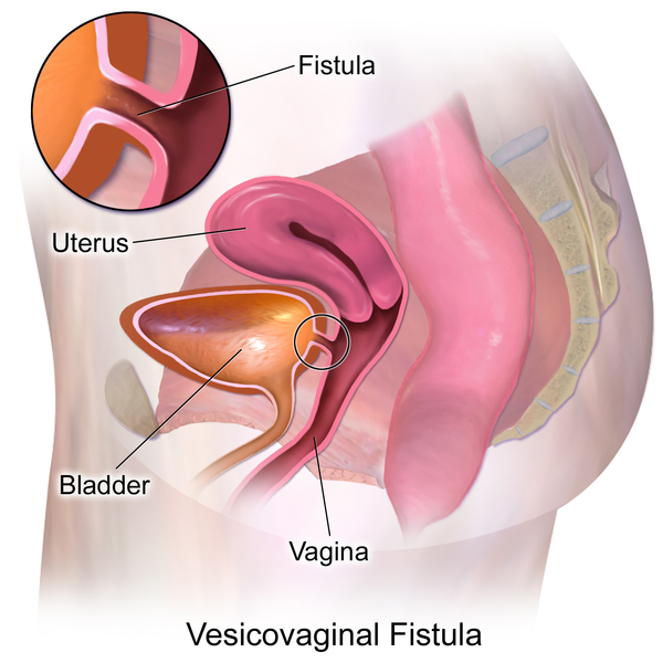 File:Vesicovaginal Fistula..png