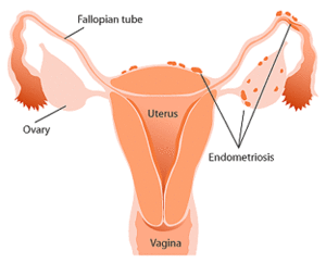 Is this a related sign of endometriosis? : r/endometriosis